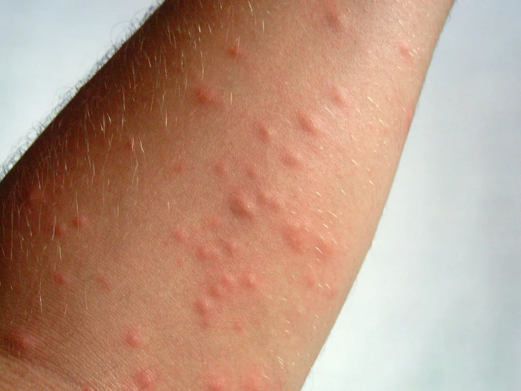 Boutons rouges sur un avant-bras après contact avec des poils de chenilles processionnaires